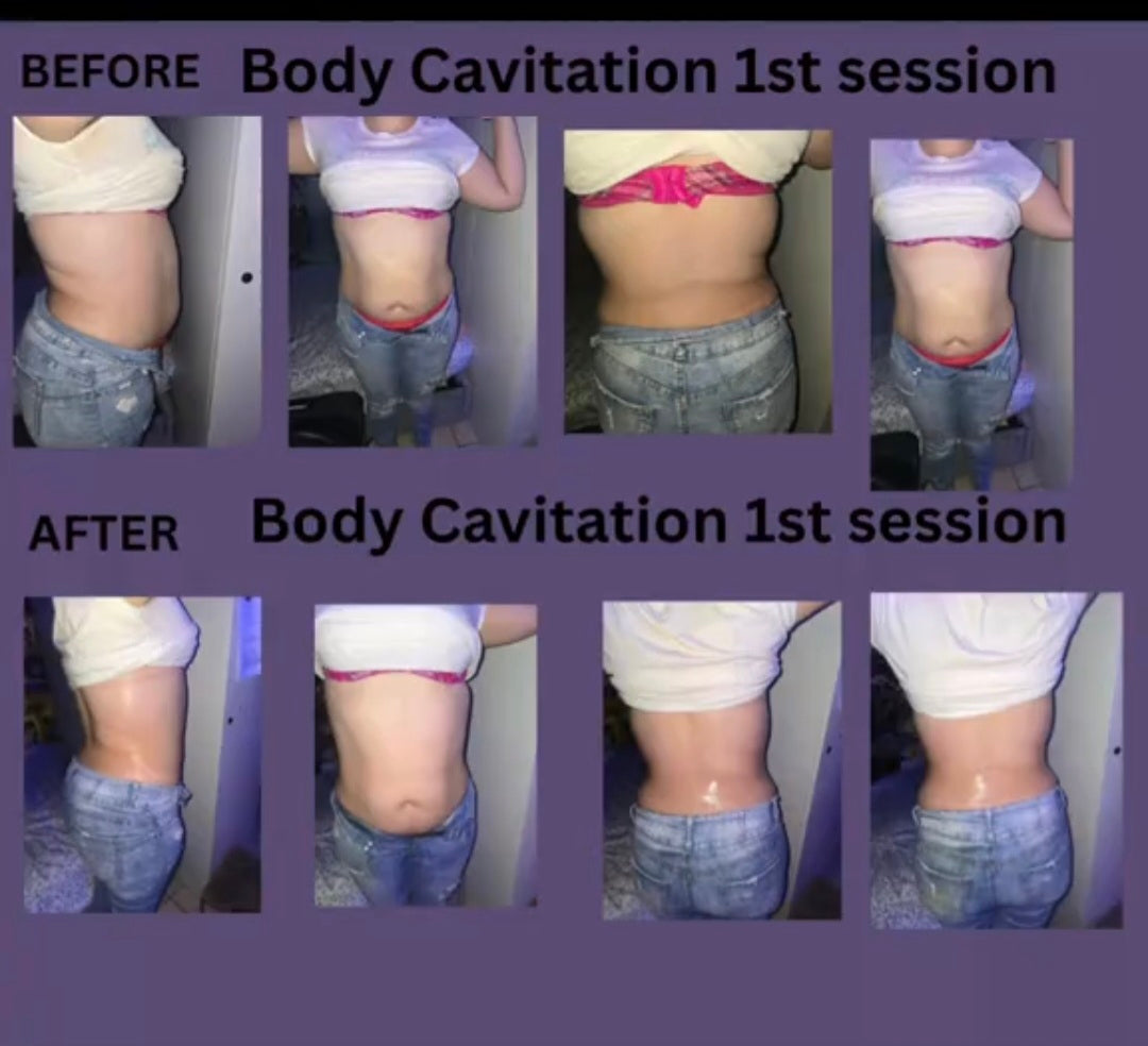 Body Countouring Non invasive